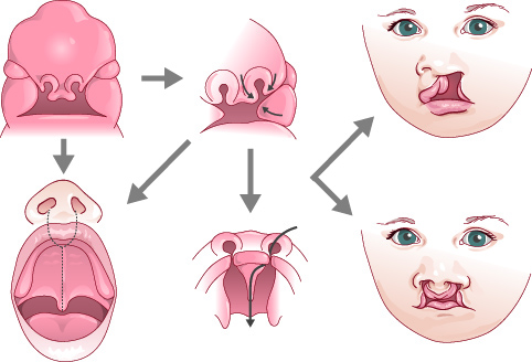 Docteur Patrice Attias - Chirurgie esthetique Maroc - malformation bouche bebe (fentes labio-palatines)